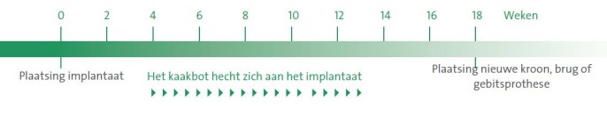 tijdsverloop implantaat behandeling