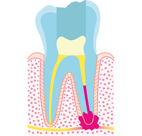 Injectie het is mooi Houden Uitleg Wortelkanaalbehandeling Stap voor Stap - Dental Clinics