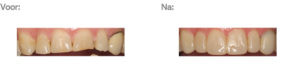 Dahlmethode herstel gebitsslijtage Dental Clinics Leeuwarden Oostergrachtswal
