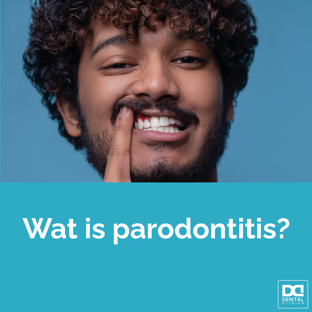 Parodontitis FAQ - oorzaak en behandeling parodontitis Dental Clinics